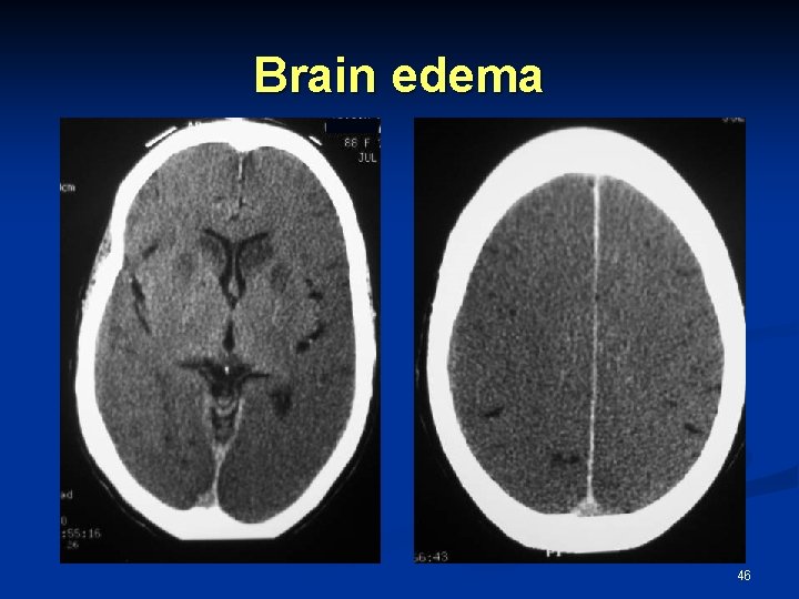 Brain edema 46 