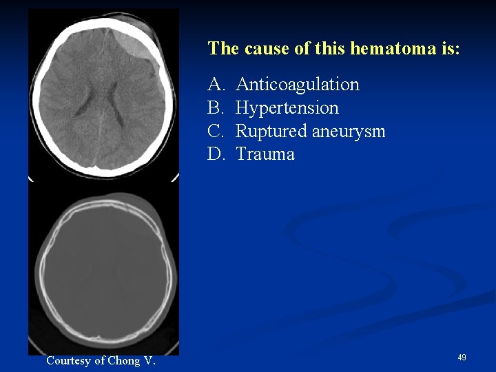 The cause of this hematoma is: A. B. C. D. Courtesy of Chong V.