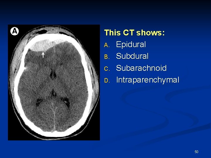 This CT shows: A. Epidural B. Subdural C. Subarachnoid D. Intraparenchymal 50 