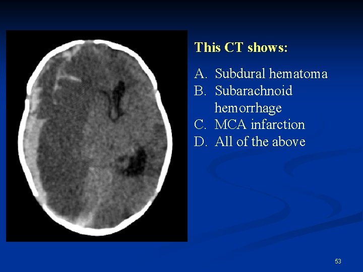 This CT shows: A. Subdural hematoma B. Subarachnoid hemorrhage C. MCA infarction D. All