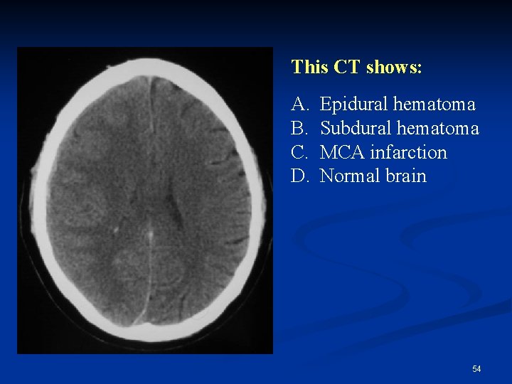 This CT shows: A. B. C. D. Epidural hematoma Subdural hematoma MCA infarction Normal