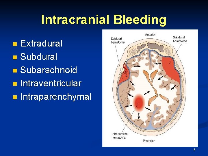 Intracranial Bleeding Extradural n Subarachnoid n Intraventricular n Intraparenchymal n 6 