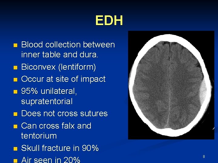 EDH n n n n Blood collection between inner table and dura. Biconvex (lentiform)