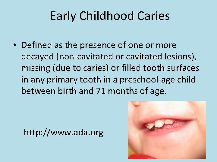  Early Childhood Caries • Defined as the presence of one or more decayed