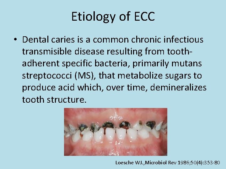 Etiology of ECC • Dental caries is a common chronic infectious transmisible disease resulting
