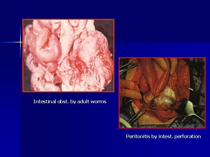 Intestinal obst. by adult worms Peritonitis by intest. perforation 