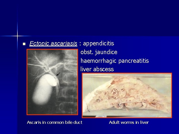 n Ectopic ascariasis : appendicitis obst. jaundice haemorrhagic pancreatitis liver abscess Ascaris in common