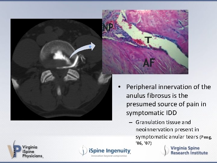  • Peripheral innervation of the anulus fibrosus is the presumed source of pain