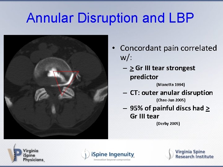 Annular Disruption and LBP • Concordant pain correlated w/: – > Gr III tear