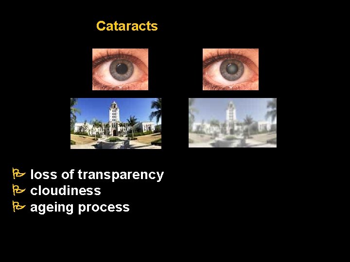 Cataracts loss of transparency cloudiness ageing process 