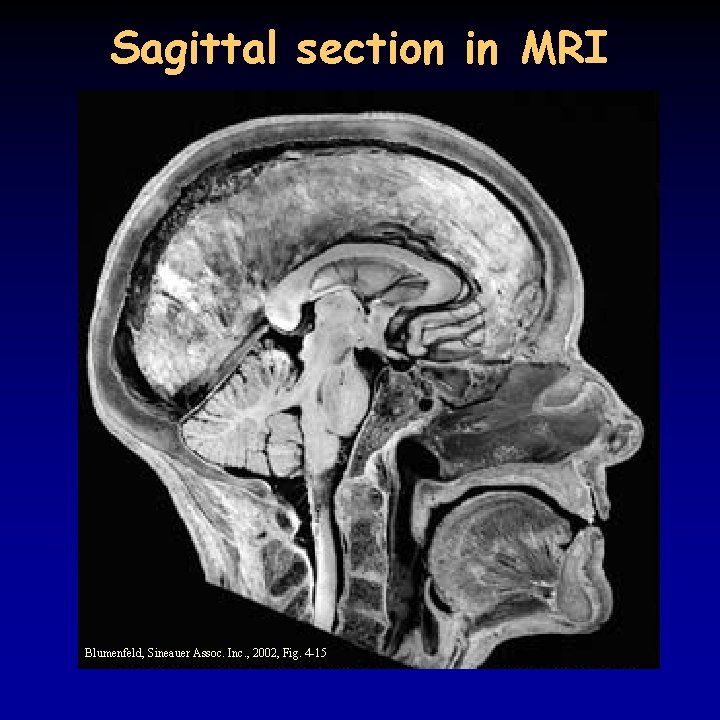 Sagittal section in MRI Blumenfeld, Sineauer Assoc. Inc. , 2002, Fig. 4 -15 