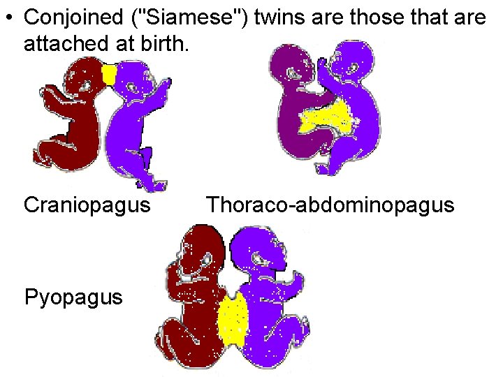  • Conjoined ("Siamese") twins are those that are attached at birth. Craniopagus Pyopagus