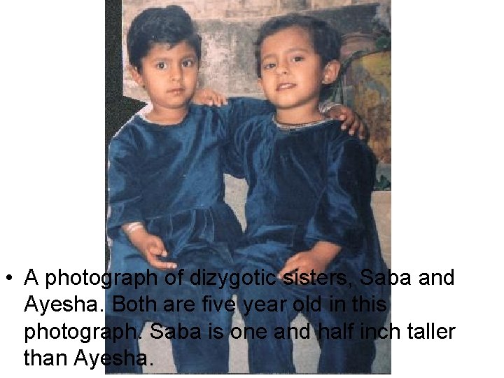  • A photograph of dizygotic sisters, Saba and Ayesha. Both are five year