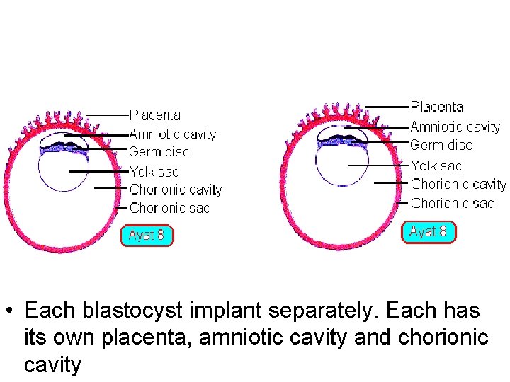  • Each blastocyst implant separately. Each has its own placenta, amniotic cavity and