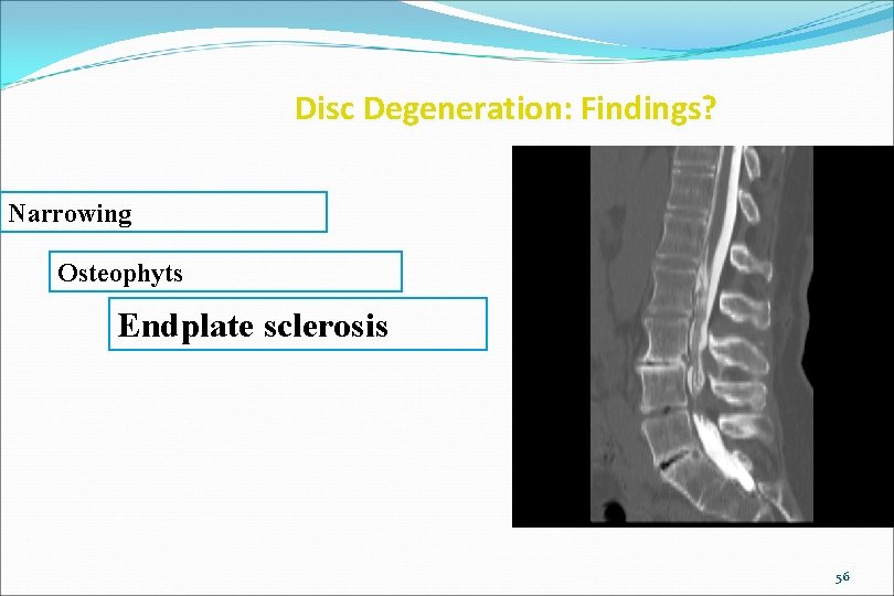 Disc Degeneration: Findings? Narrowing Osteophyts Endplate sclerosis 56 