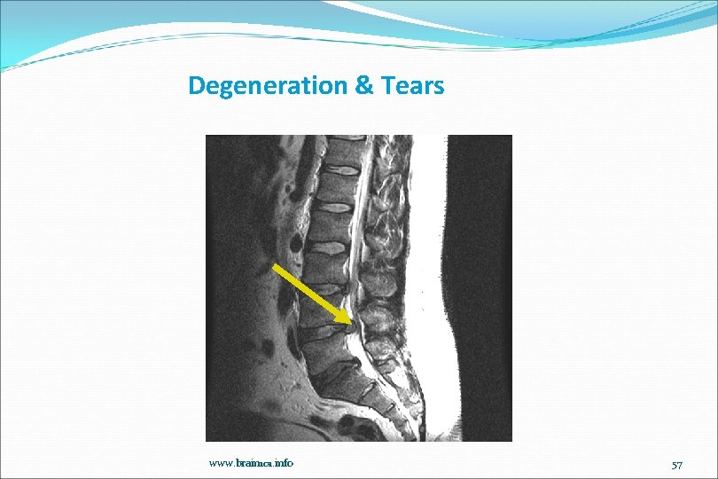 Degeneration & Tears www. brain 101. info 57 