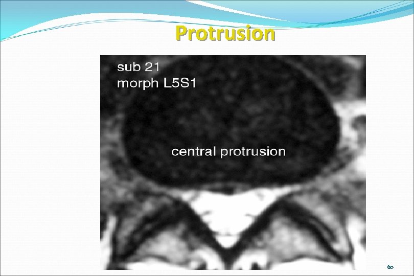 Protrusion www. brain 101. info 60 