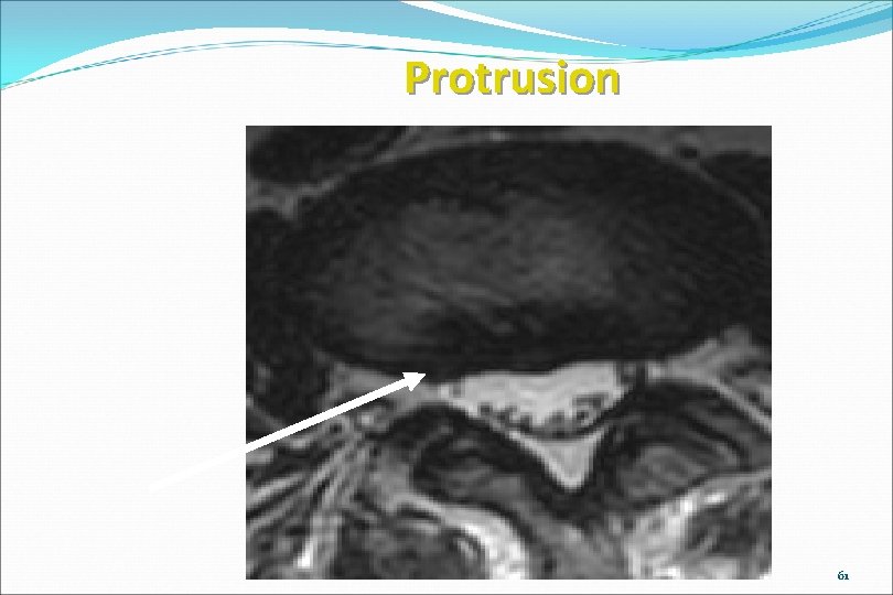 Protrusion www. brain 101. info 61 