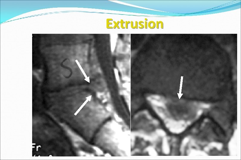 Extrusion www. brain 101. info 62 