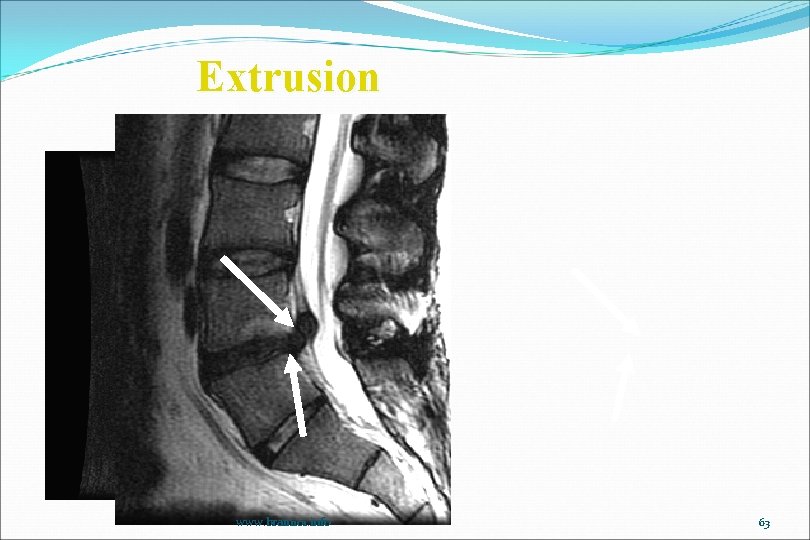 Extrusion www. brain 101. info 63 