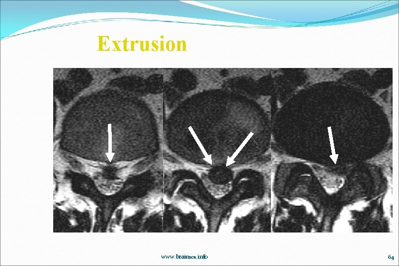 Extrusion www. brain 101. info 64 