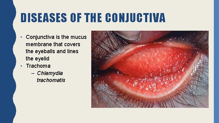 DISEASES OF THE CONJUCTIVA • Conjunctiva is the mucus membrane that covers the eyeballs