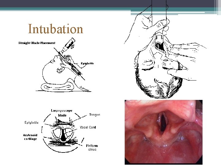 Intubation 