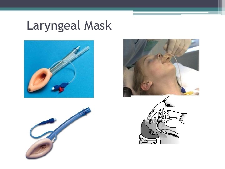 Laryngeal Mask 