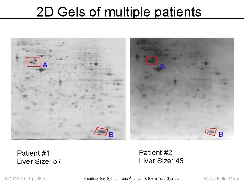 2 D Gels of multiple patients Patient #1 Liver Size: 57 25/11/2009 - Pg.