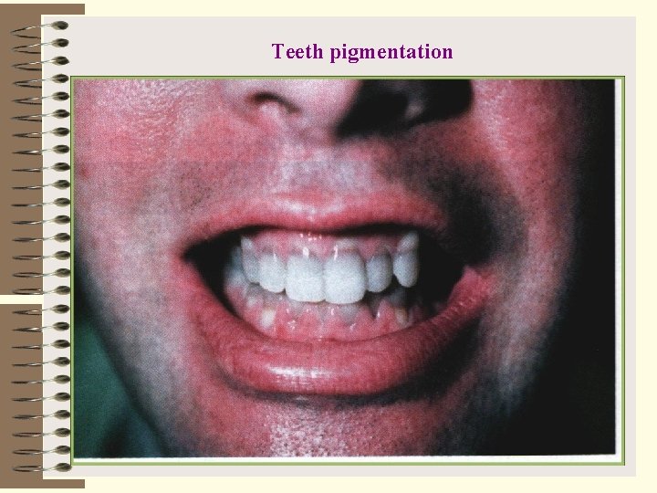 Teeth pigmentation 