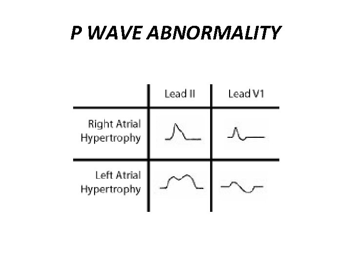 P WAVE ABNORMALITY 