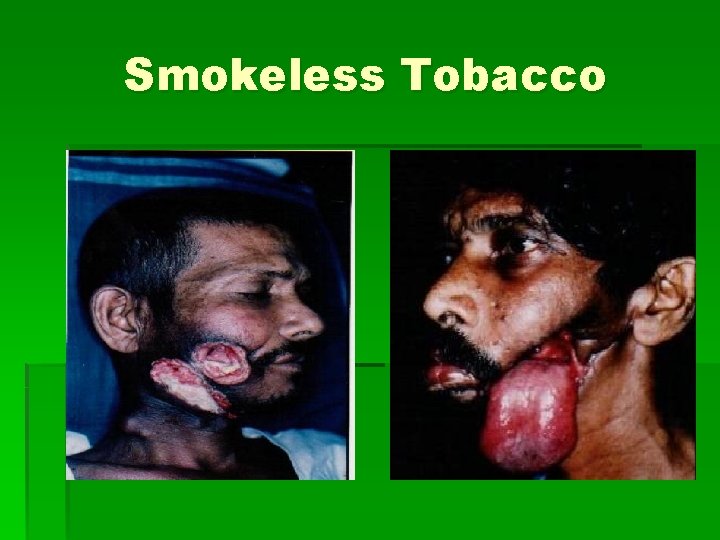 Smokeless Tobacco 