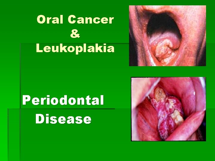Oral Cancer & Leukoplakia Periodontal Disease 