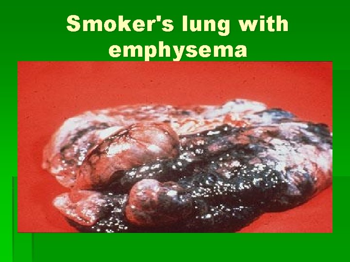 Smoker's lung with emphysema 
