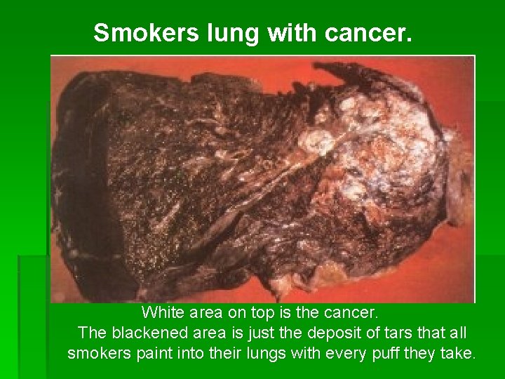 Smokers lung with cancer. White area on top is the cancer. The blackened area