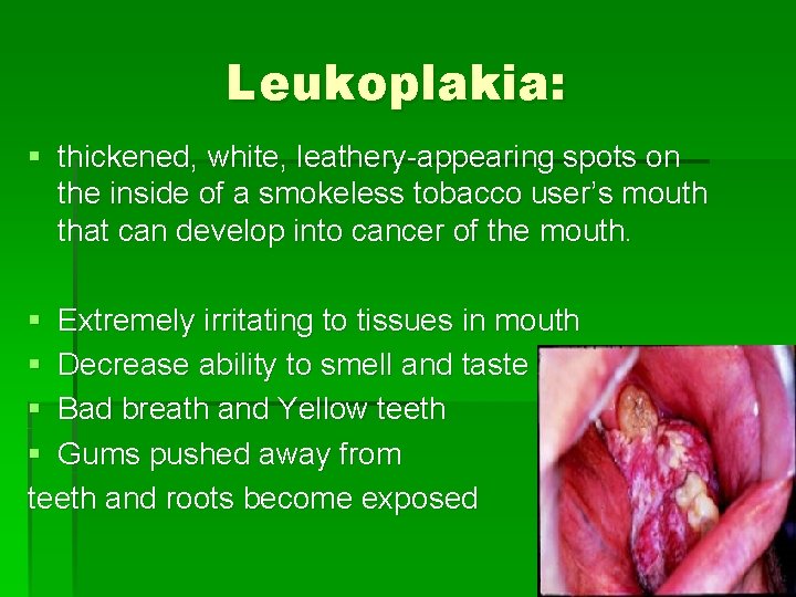 Leukoplakia: § thickened, white, leathery-appearing spots on the inside of a smokeless tobacco user’s