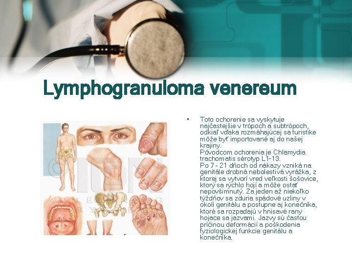 Lymphogranuloma venereum • Toto ochorenie sa vyskytuje najčastejšie v trópoch a subtrópoch, odkiaľ vďaka