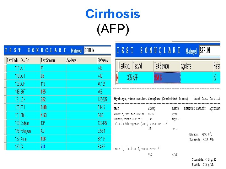 Cirrhosis (AFP) 