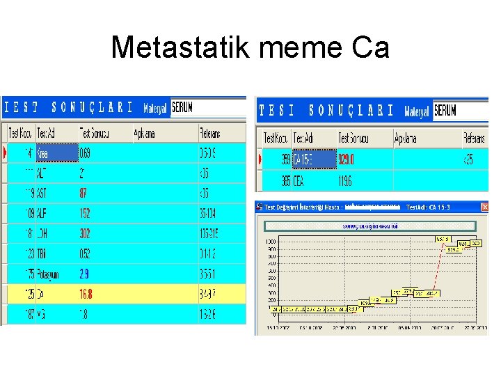 Metastatik meme Ca 