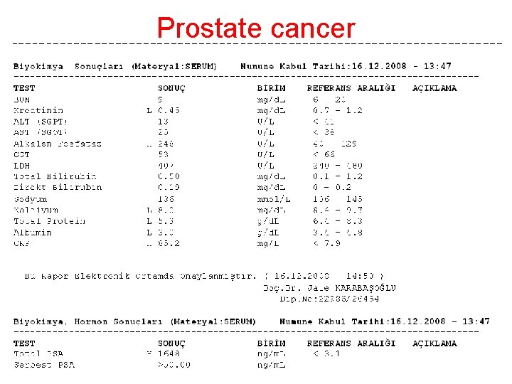 Prostate cancer 