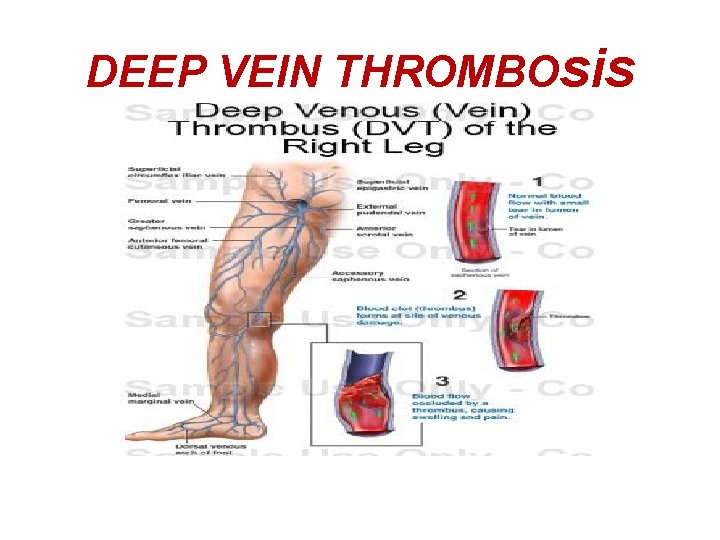 DEEP VEIN THROMBOsis 