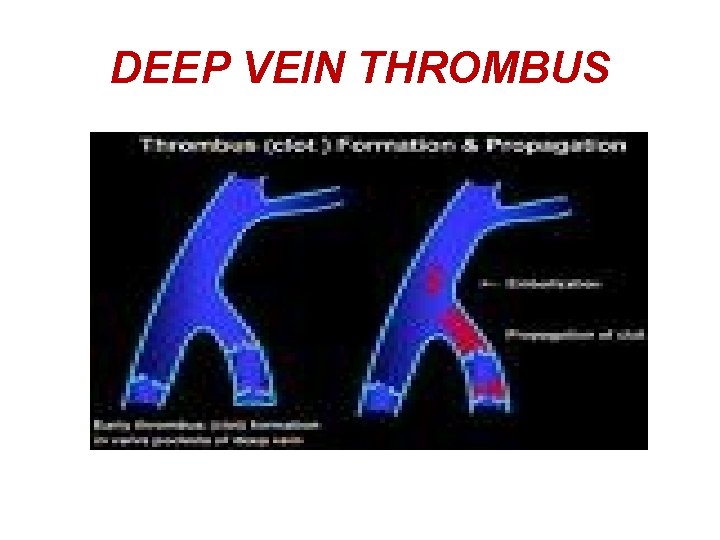 DEEP VEIN THROMBUS 