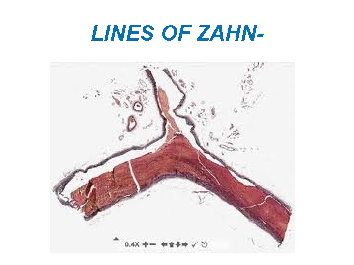 LINES OF ZAHN- 