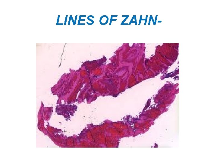 LINES OF ZAHN- 
