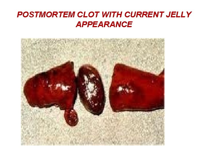 POSTMORTEM CLOT WITH CURRENT JELLY APPEARANCE 