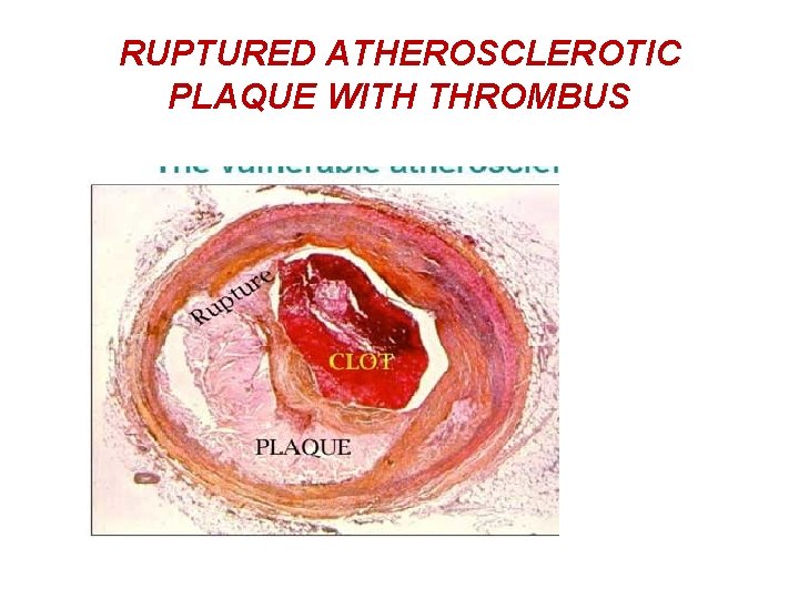 RUPTURED ATHEROSCLEROTIC PLAQUE WITH THROMBUS 