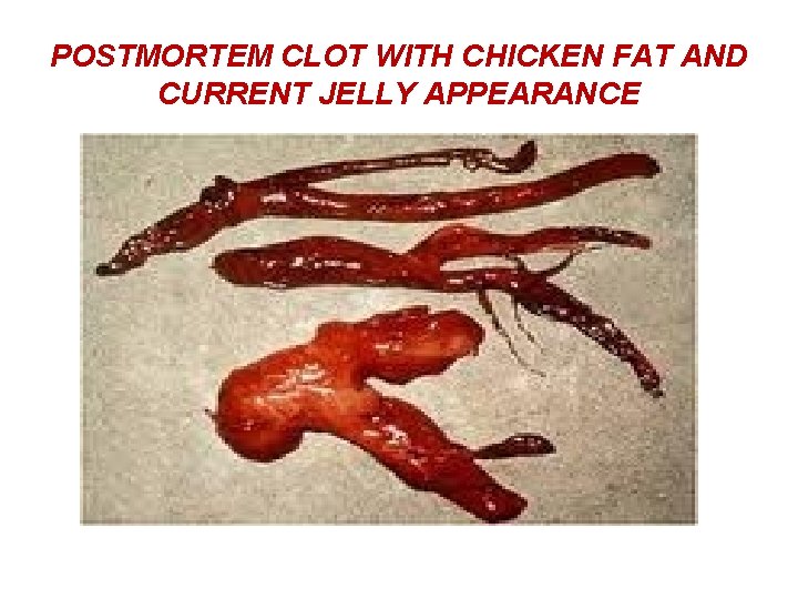 POSTMORTEM CLOT WITH CHICKEN FAT AND CURRENT JELLY APPEARANCE 