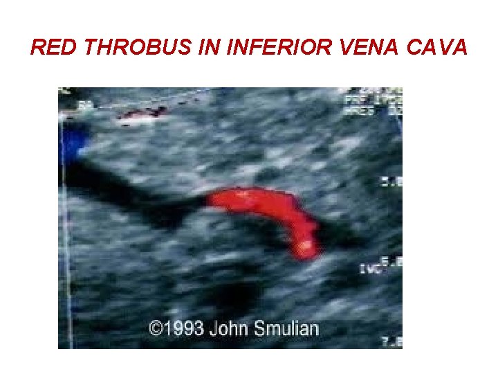 RED THROBUS IN INFERIOR VENA CAVA 