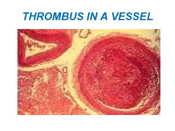 THROMBUS IN A VESSEL 