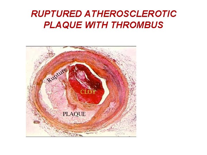 RUPTURED ATHEROSCLEROTIC PLAQUE WITH THROMBUS 